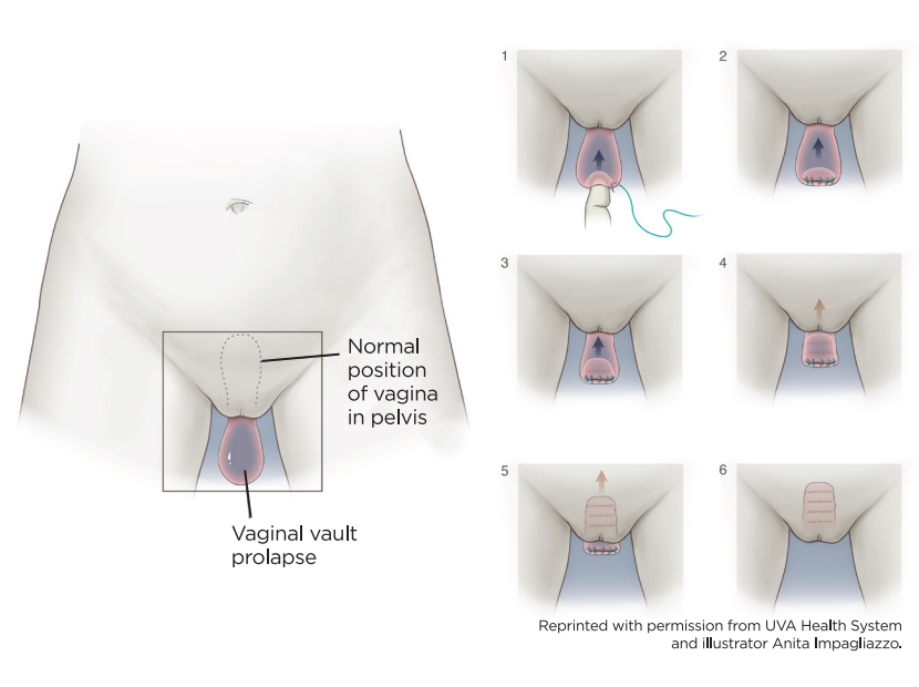 Colpocleisis Vaginal Closure Surgery - Brazosport Women's Health