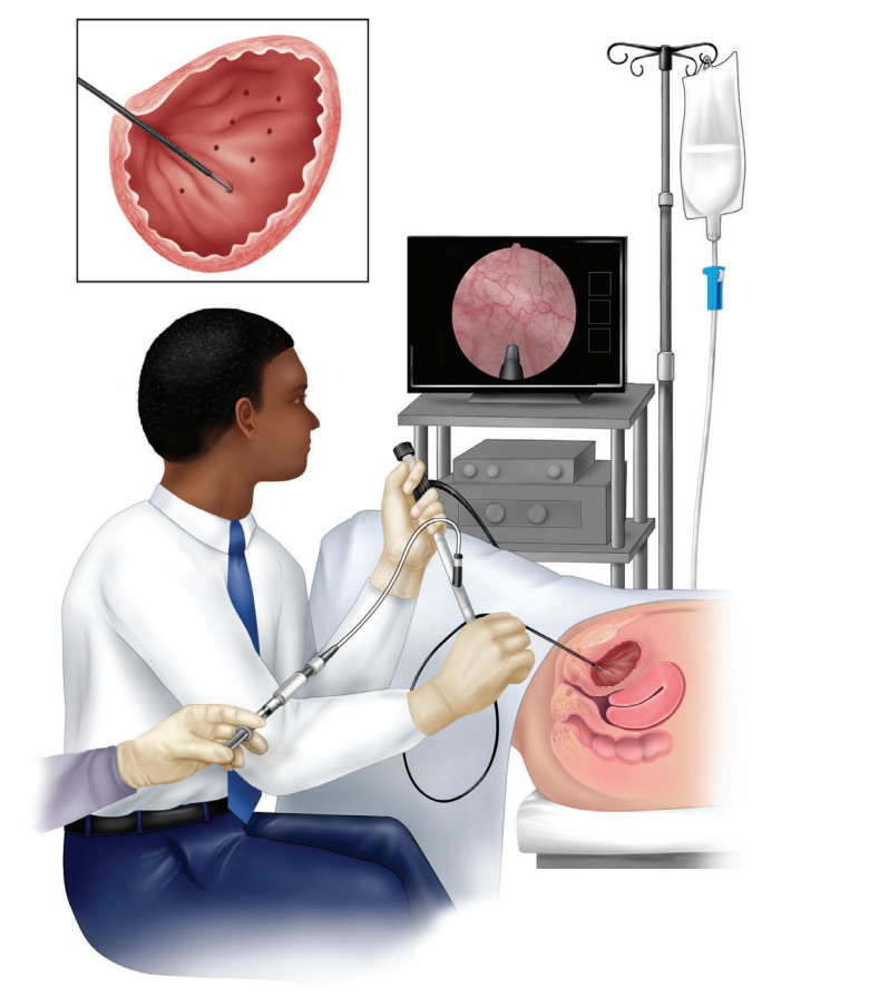 Urinary System Incontinence Diagnosis And Treatment