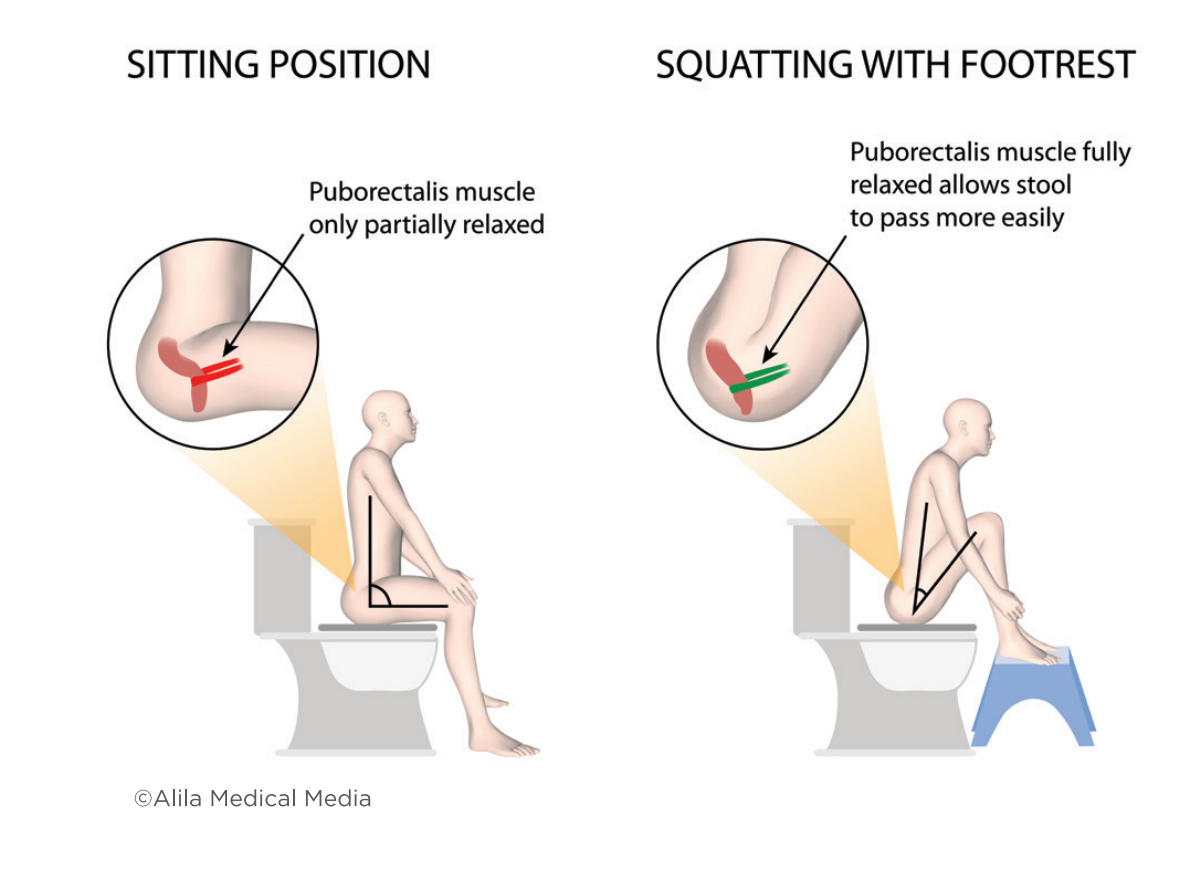 Constipated? Here's How To Return To Normal Bowel Movement