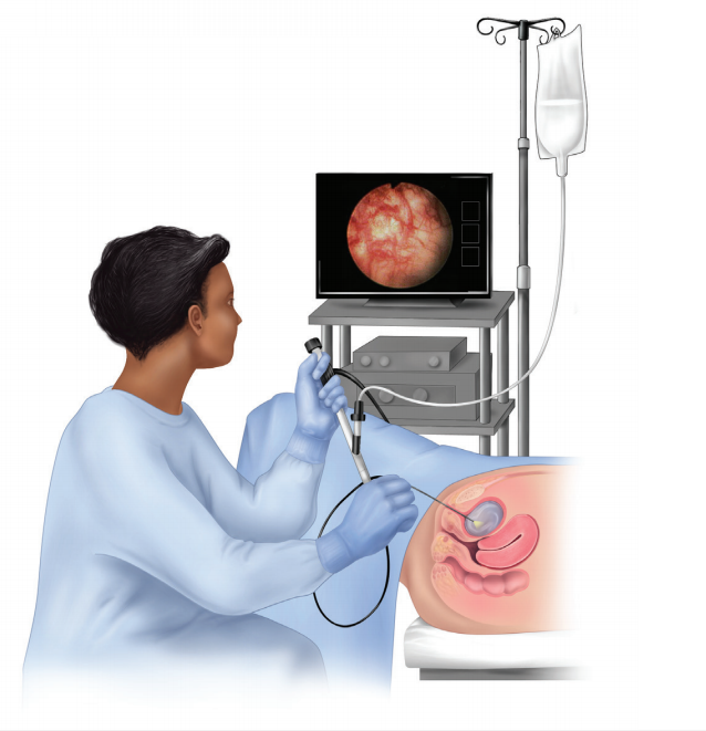 Cystoscopy  Brazosport Women's Health