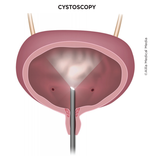 Screenshot 68 - Cystoscopy 3