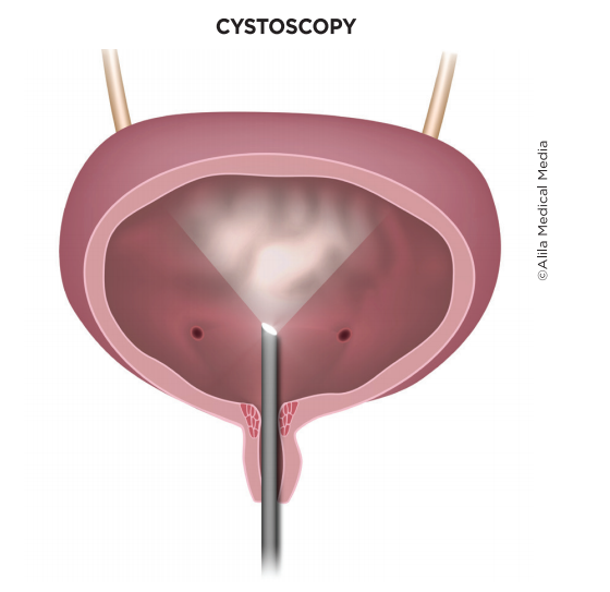 Cystoscopy - Brazosport Women's Health