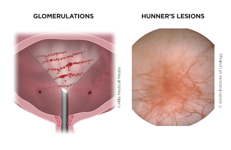 Interstitial Cystitis/ Bladder Pain Syndrome - Brazosport Women's