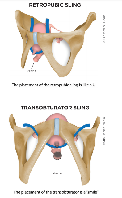 Mid-urethral Sling for Stress Urinary Incontinence - Brazosport Women's  Health