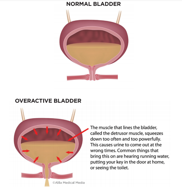 Urethral Bulking for Stress Urinary incontinence - Brazosport