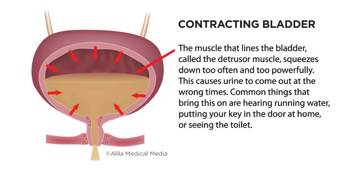 Urethral Bulking for Stress Urinary incontinence - Brazosport