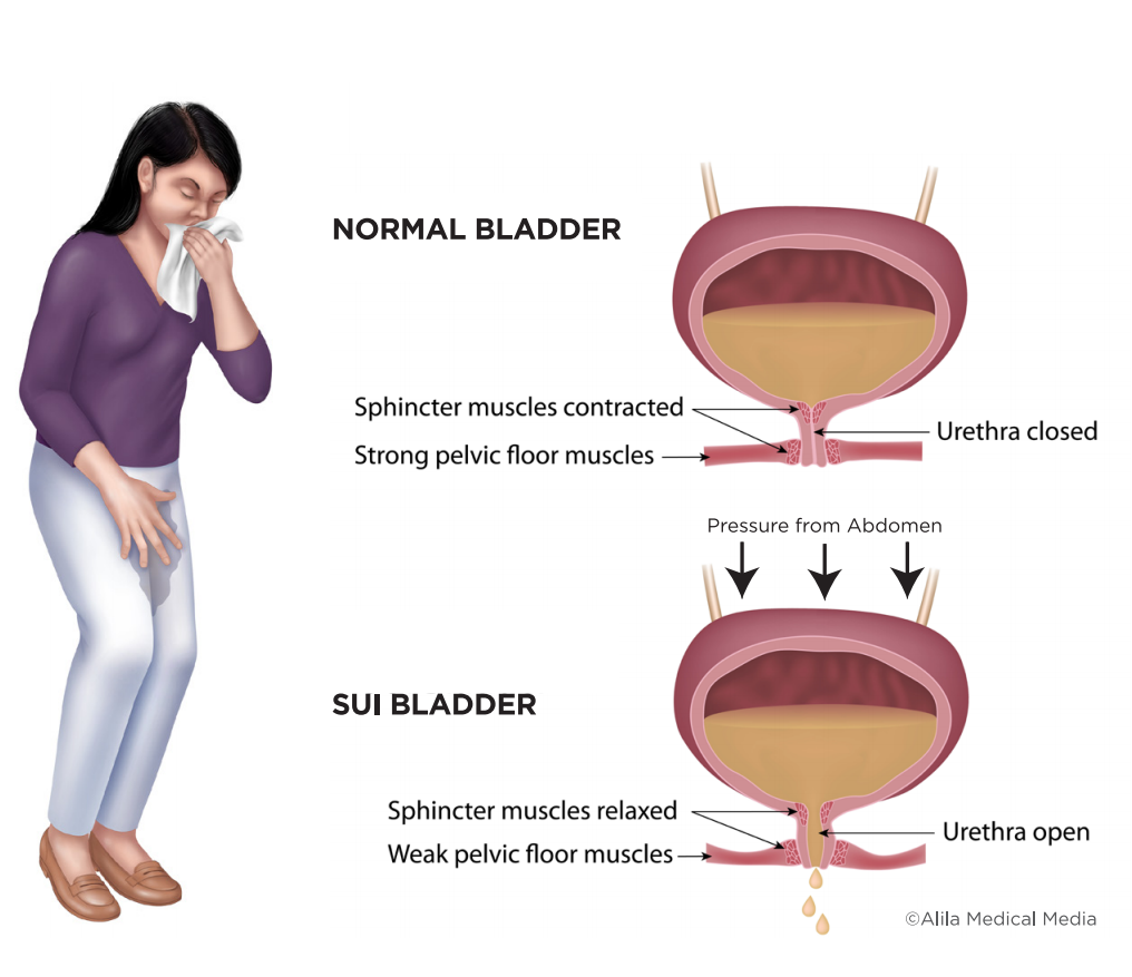 Ощущение пузыря. Стресс недержание мочи у женщин. Girl bladder Incontinence.