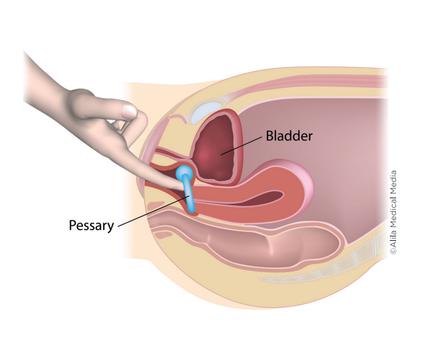 Stress Urinary Incontinence - Brazosport Women's Health