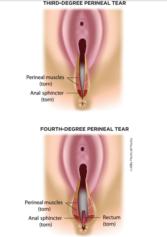 Screenshot 84 - Third And Fourth Degree Perineal Tears 3