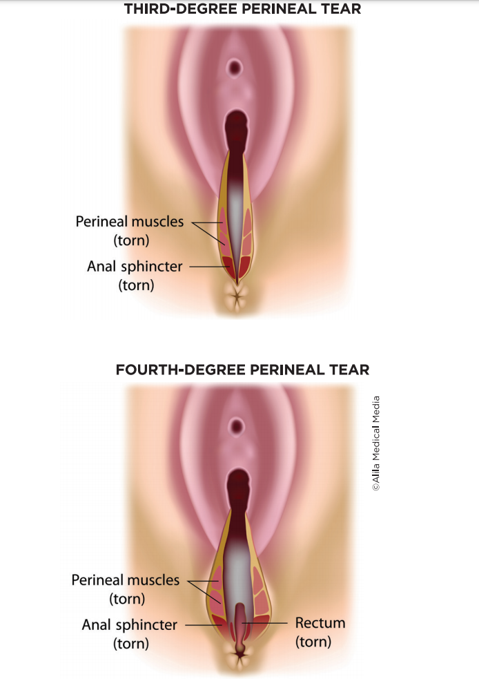 Third and Fourth Degree Perineal Tears Brazosport Women s Health