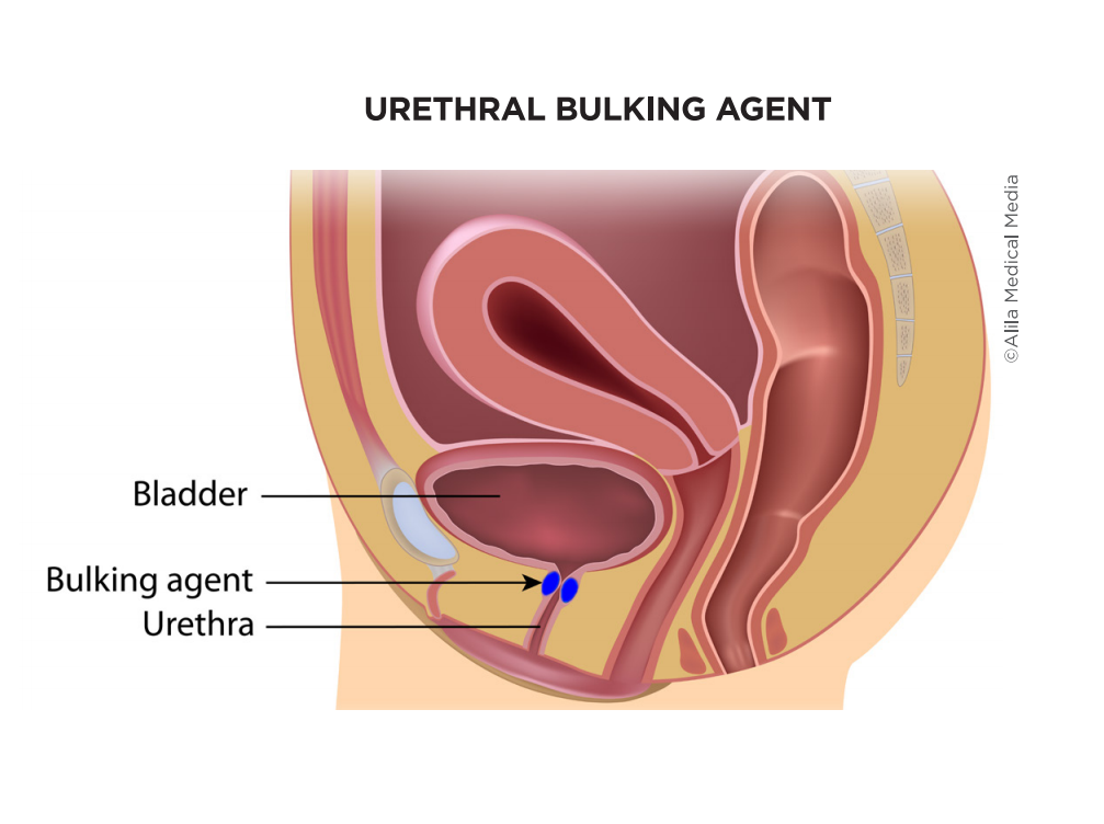Screenshot 85 - Urethral Bulking For Stress Urinary Incontinence 1