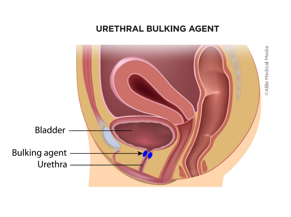 Urethral Bulking for Stress Urinary incontinence - Brazosport