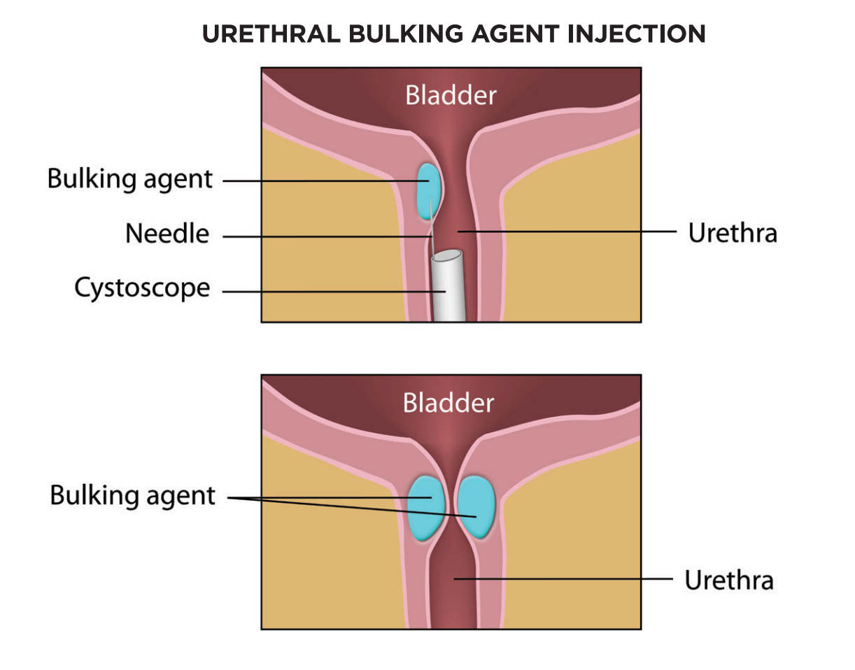 Screenshot 86 - Urethral Bulking For Stress Urinary Incontinence 3