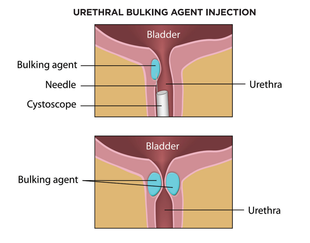 Urethral Bulking for Stress Urinary incontinence - Brazosport