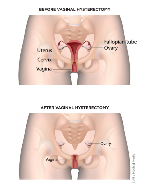 Screenshot 90 - Vaginal Hysterectomy For Prolapse 1