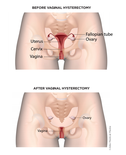 Vaginal Hysterectomy for Prolapse - Brazosport Women's Health