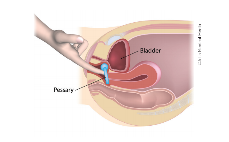 Pessaries for Prolapse