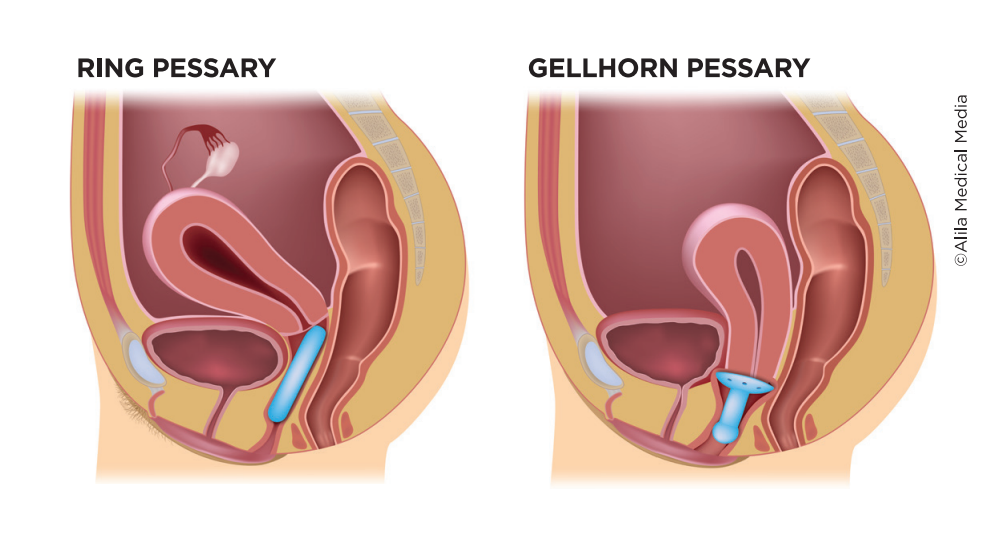 bladder prolapse pessary