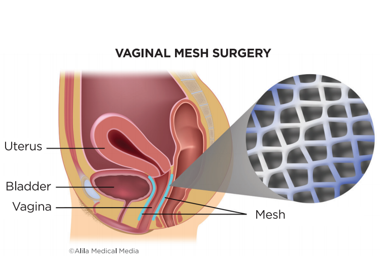 Screenshot 94 - Vaginal Prolapse Repair Surgery Using Mesh/Biological Graft 3