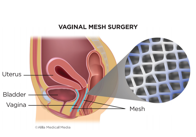 Vaginal Prolapse Repair Surgery using Mesh/Biological Graft - Brazosport  Women's Health